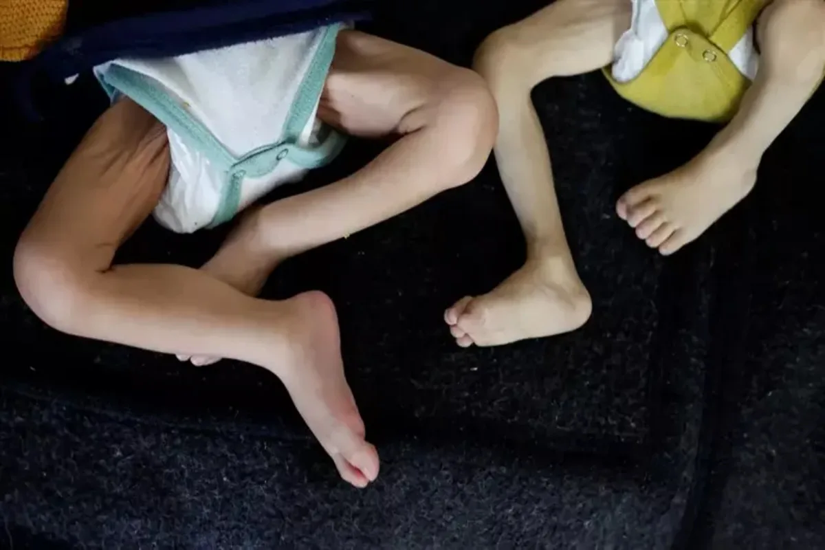 ألمانيا تراجع خطط استقبال أطفال غزة للعلاج الطبي